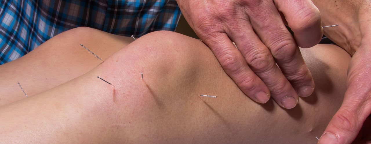Dry-Needling-iMove-Physcial-Therapy-St-Louis-Joplin-Chesterfield-Kansas-City-Joplin-MO-Tulsa-OK-Metro-East-IL