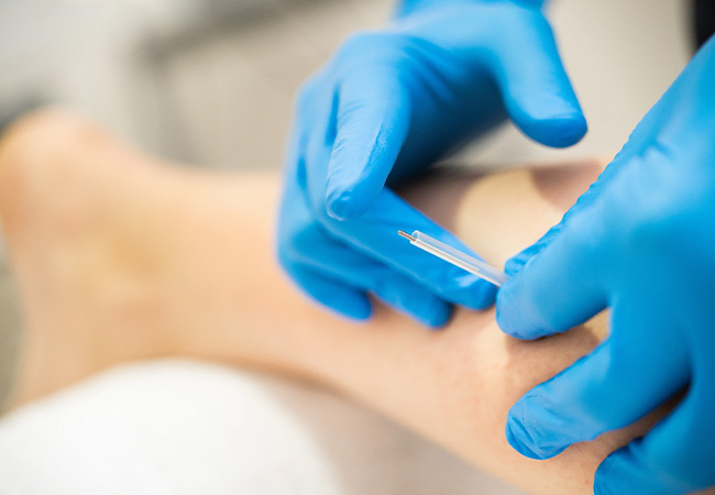 Uncover Long-Lasting Pain Relief With Dry Needling