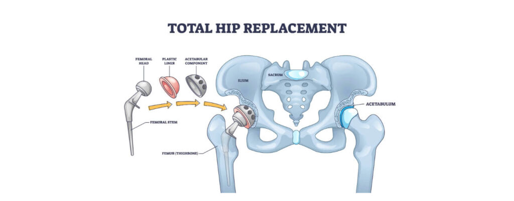 Hip Replacement